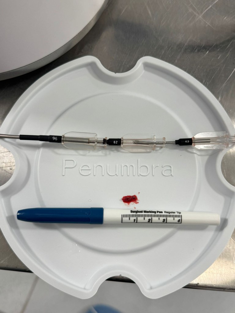 Trombectomía cerebral