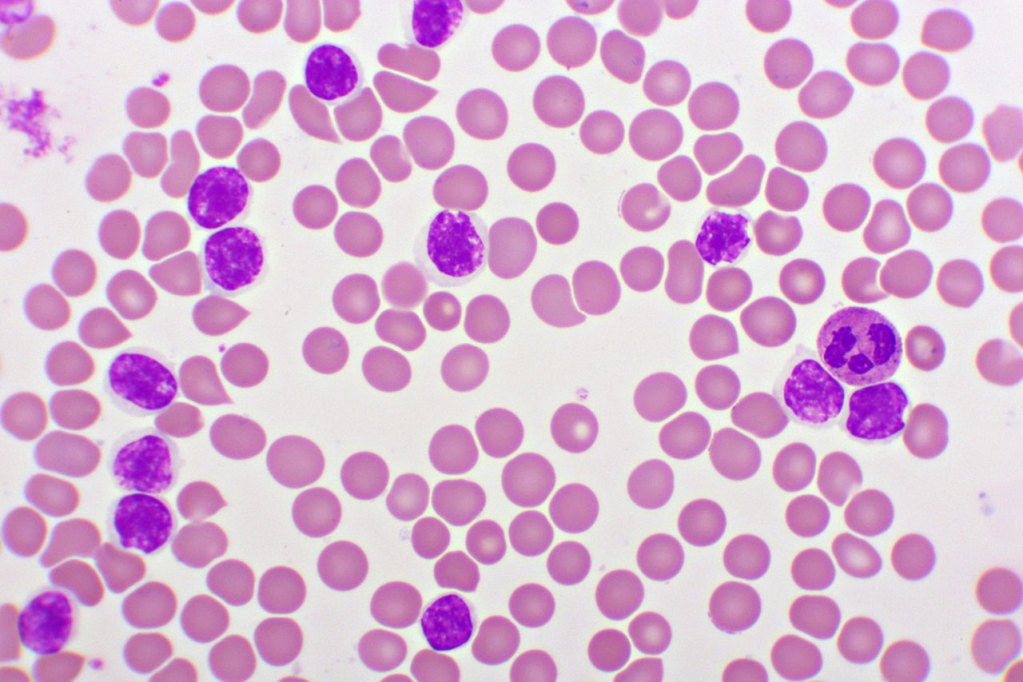 Lymphocytic Leukemia under microscope.